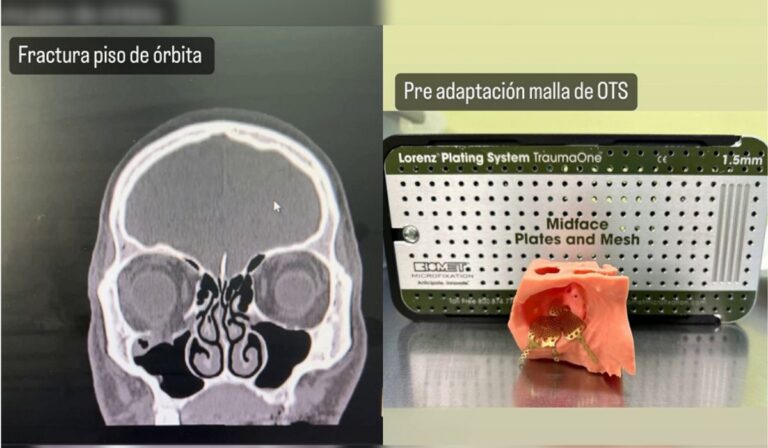 Hospital de Parral realizó exitosa cirugía maxilofacial