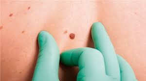 Advierten sobre incidencia de cáncer de piel en pacientes jóvenes