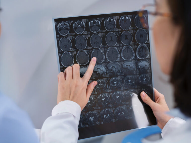 ACV, Alzheimer o demencias: ¿Cuáles son las enfermedades cerebrales más comunes en Chile?